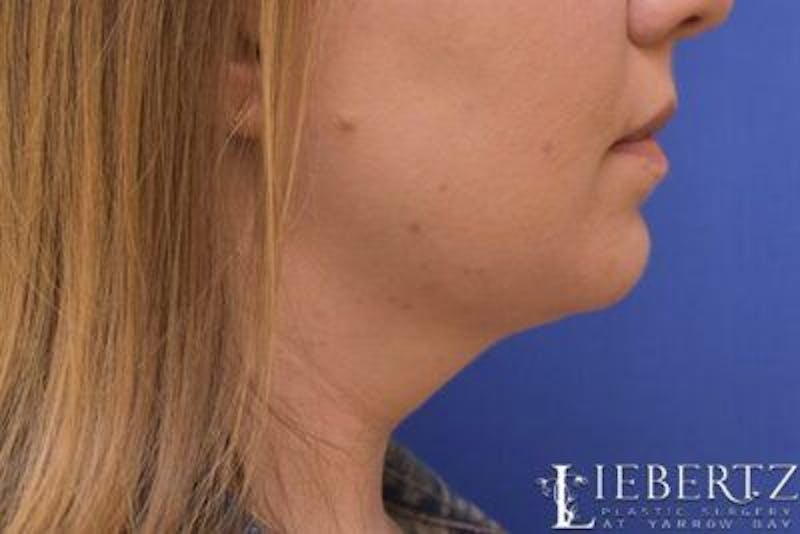 Submental Liposuction Before & After Gallery - Patient 138593 - Image 4