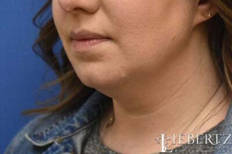 Submental Liposuction Before & After Gallery - Patient 138593 - Image 7