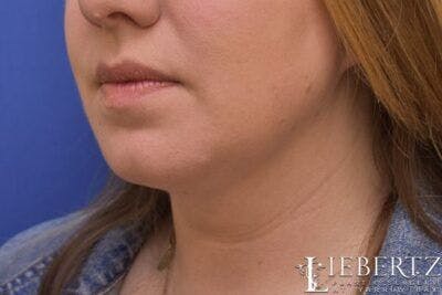 Submental Liposuction Before & After Gallery - Patient 138593 - Image 2