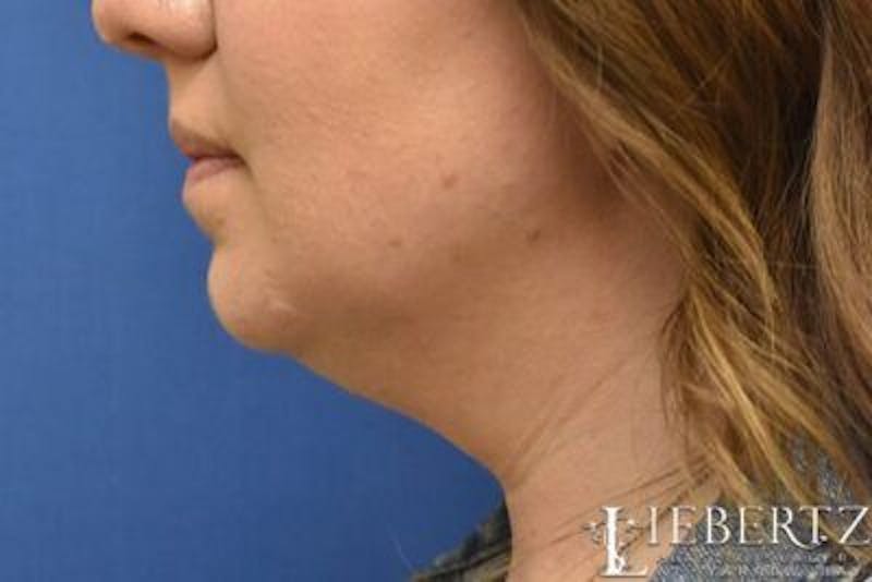 Submental Liposuction Before & After Gallery - Patient 138593 - Image 9