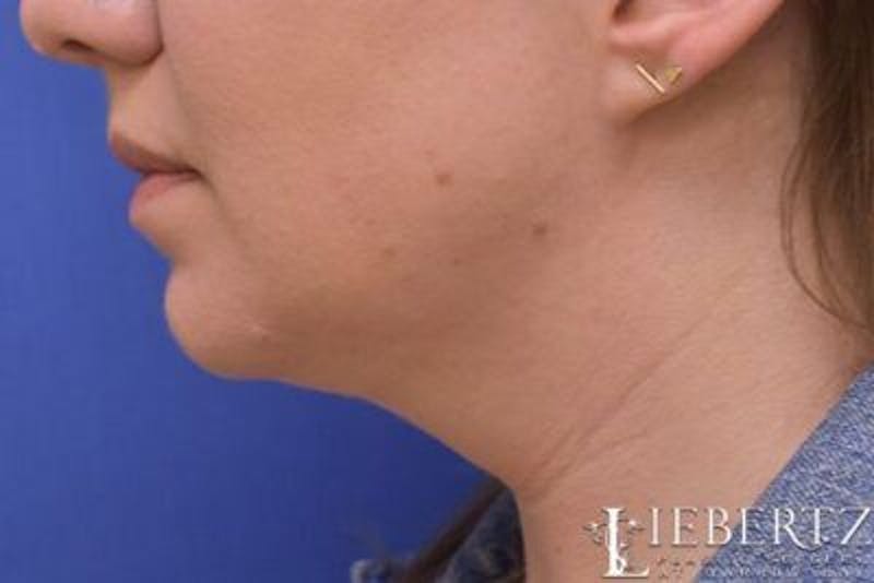 Submental Liposuction Before & After Gallery - Patient 138593 - Image 10
