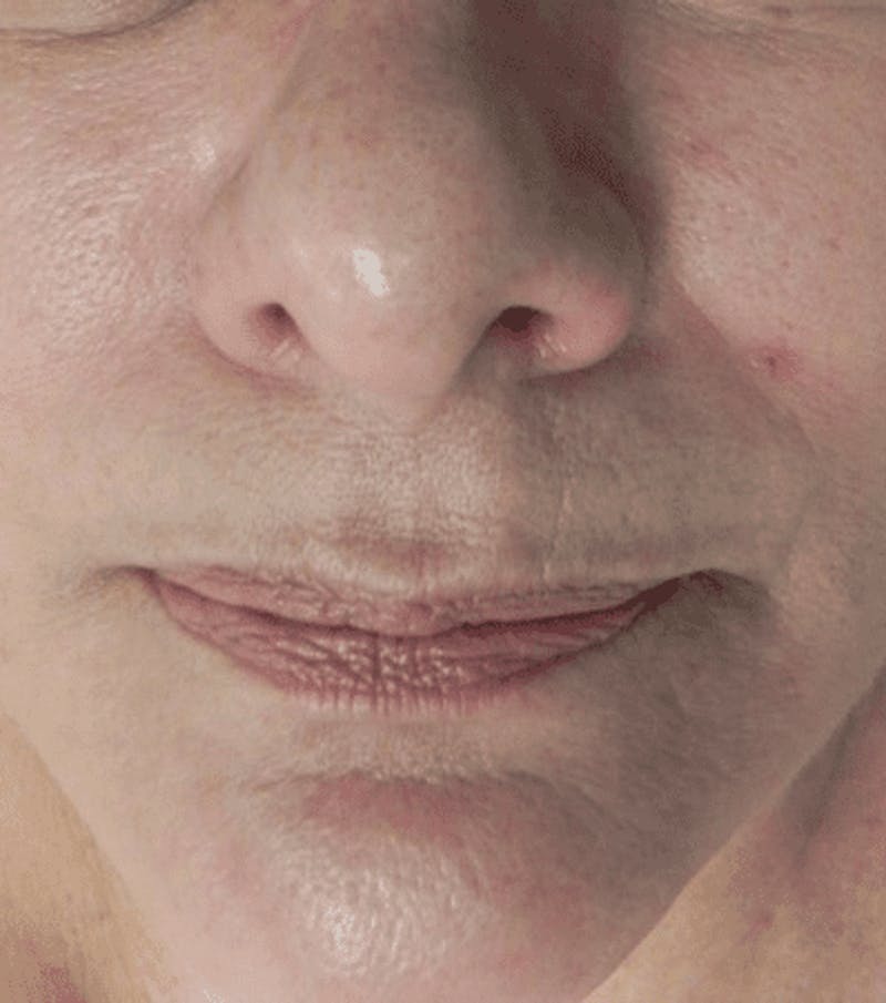 Microneedling Before & After Gallery - Patient 318261 - Image 1