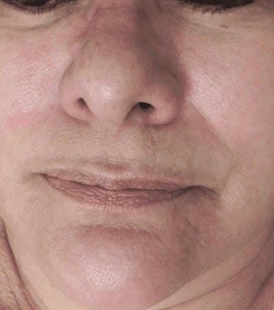 Microneedling Before & After Gallery - Patient 318261 - Image 2