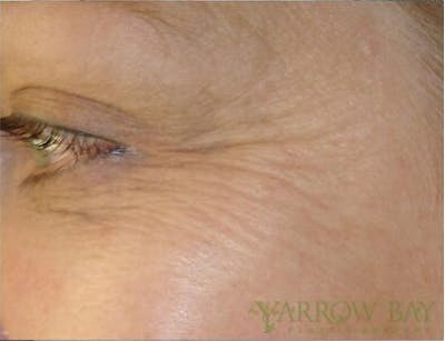 Microneedling Before & After Gallery - Patient 206113 - Image 1