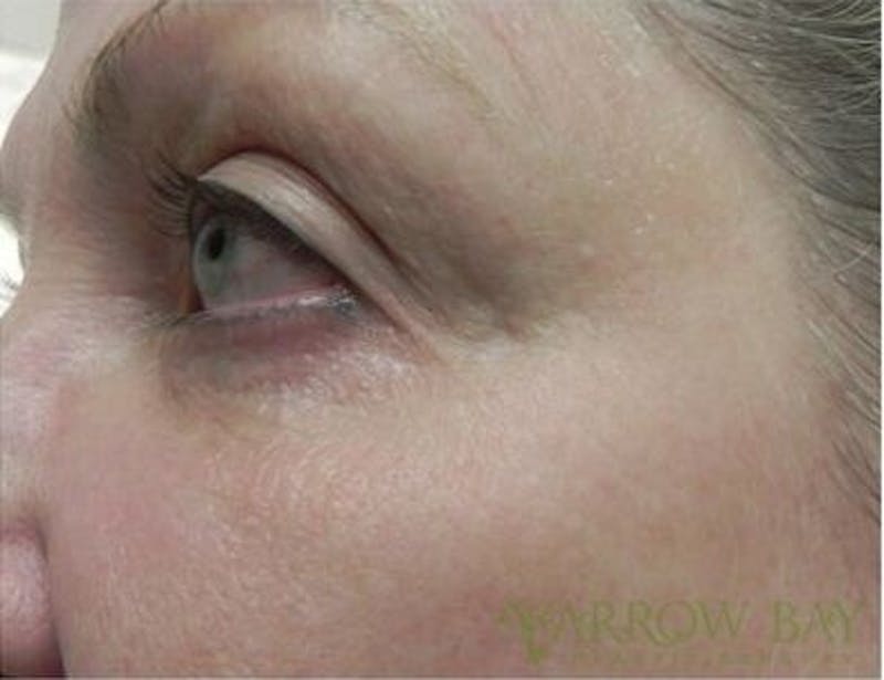 Microneedling Before & After Gallery - Patient 206113 - Image 2