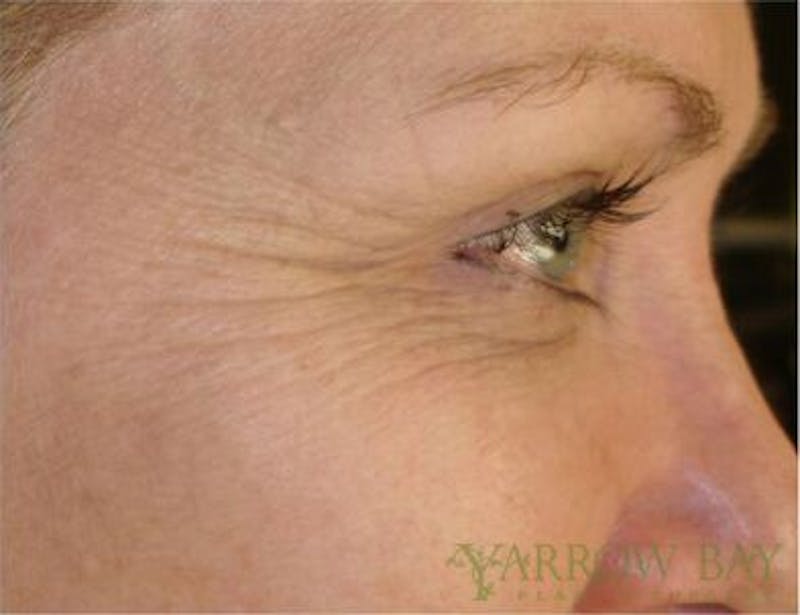 Microneedling Before & After Gallery - Patient 206113 - Image 3