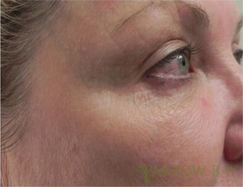 Microneedling Before & After Gallery - Patient 206113 - Image 4