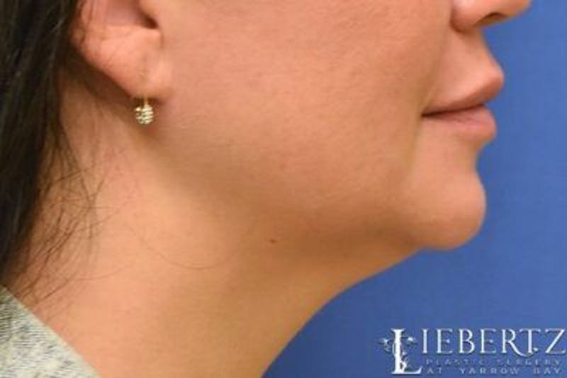 Submental Liposuction Before & After Gallery - Patient 366460 - Image 1