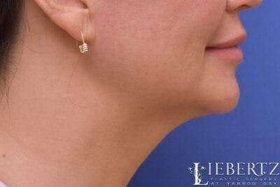 Submental Liposuction Before & After Gallery - Patient 366460 - Image 2