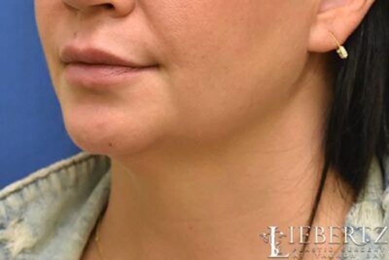 Submental Liposuction Before & After Gallery - Patient 366460 - Image 3