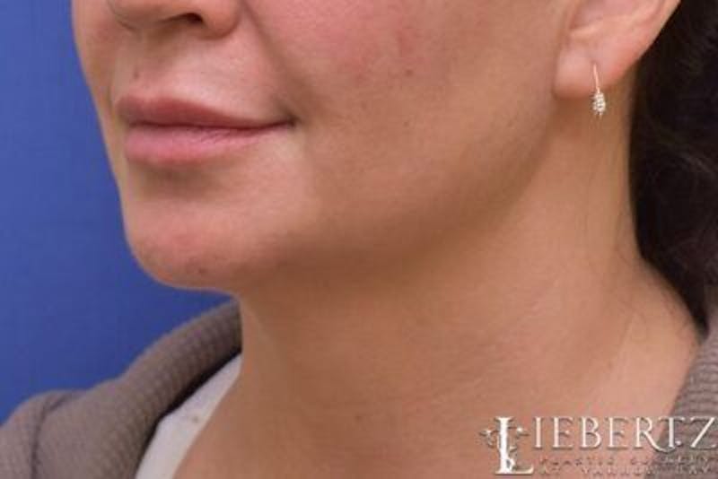 Submental Liposuction Before & After Gallery - Patient 366460 - Image 4
