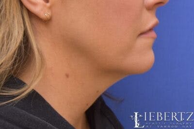 Submental Liposuction Before & After Gallery - Patient 354903 - Image 1