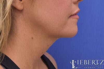 Submental Liposuction Before & After Gallery - Patient 354903 - Image 2
