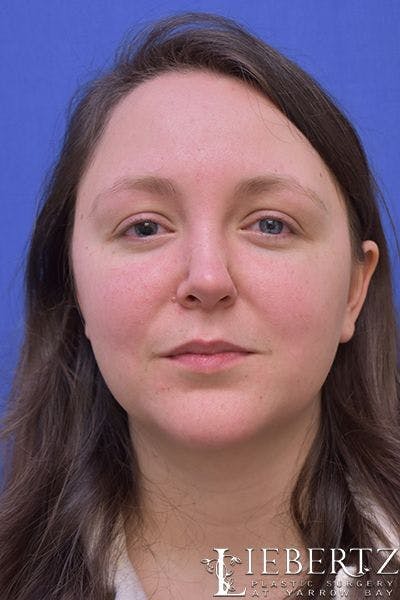 Rhinoplasty Before & After Gallery - Patient 262829 - Image 1
