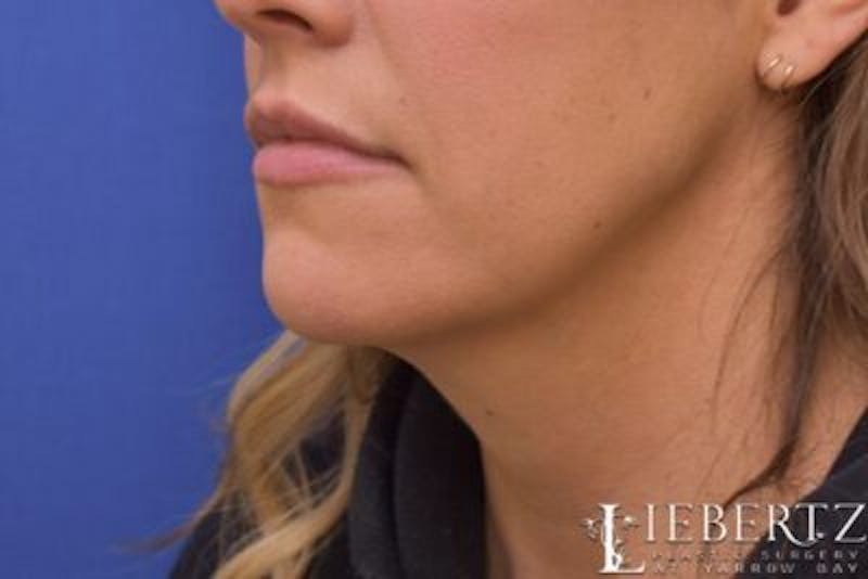 Submental Liposuction Before & After Gallery - Patient 354903 - Image 3