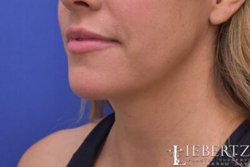 Submental Liposuction Before & After Gallery - Patient 354903 - Image 4