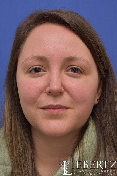 Rhinoplasty Before & After Gallery - Patient 262829 - Image 2