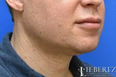 Submental Liposuction Before & After Gallery - Patient 331766 - Image 1