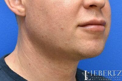 Submental Liposuction Before & After Gallery - Patient 331766 - Image 2