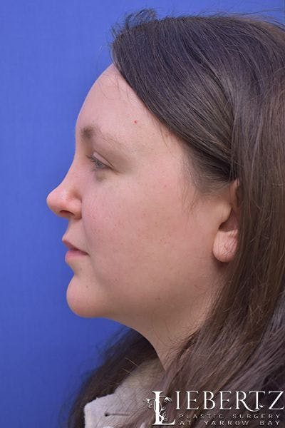 Rhinoplasty Before & After Gallery - Patient 262829 - Image 1