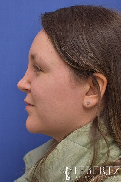 Rhinoplasty Before & After Gallery - Patient 262829 - Image 2
