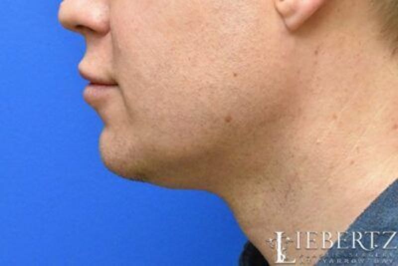 Submental Liposuction Before & After Gallery - Patient 331766 - Image 3