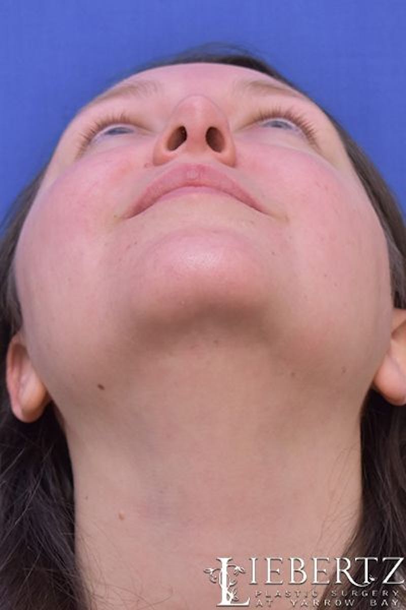 Rhinoplasty Before & After Gallery - Patient 262829 - Image 7
