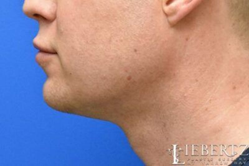 Submental Liposuction Before & After Gallery - Patient 331766 - Image 4