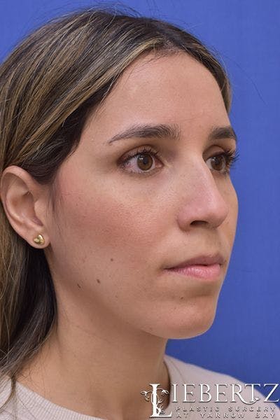 Rhinoplasty Before & After Gallery - Patient 200955 - Image 1