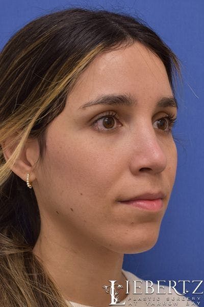 Rhinoplasty Before & After Gallery - Patient 200955 - Image 2