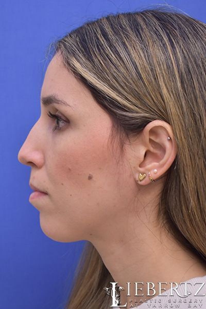 Rhinoplasty Before & After Gallery - Patient 200955 - Image 3