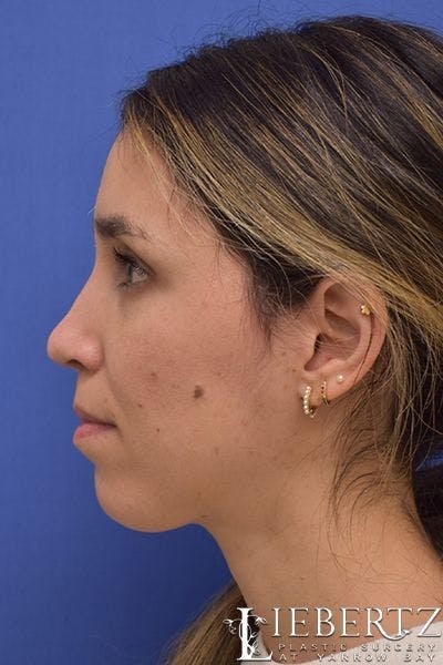 Rhinoplasty Before & After Gallery - Patient 200955 - Image 2