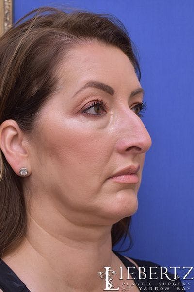 Rhinoplasty Before & After Gallery - Patient 354972 - Image 1