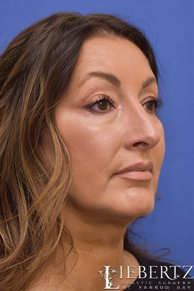 Rhinoplasty Before & After Gallery - Patient 354972 - Image 4