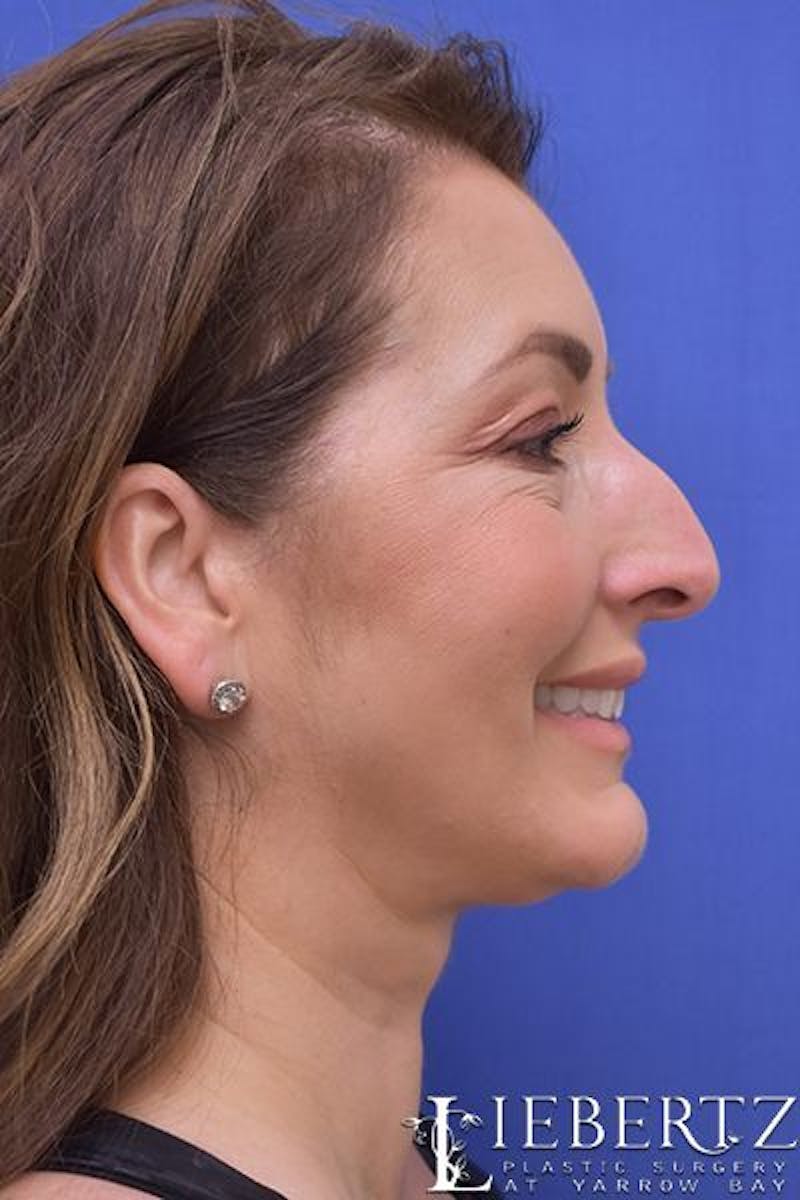 Rhinoplasty Before & After Gallery - Patient 354972 - Image 5