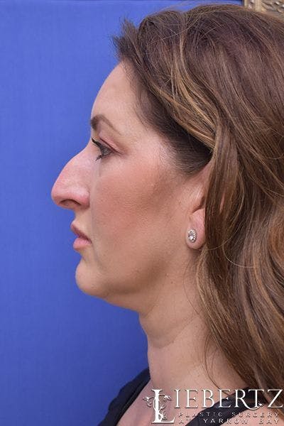 Rhinoplasty Before & After Gallery - Patient 354972 - Image 1