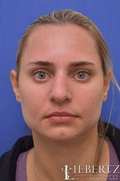 Rhinoplasty Before & After Gallery - Patient 317114 - Image 1