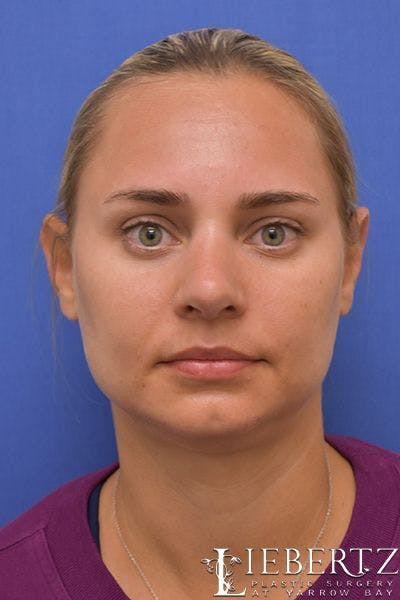 Rhinoplasty Before & After Gallery - Patient 317114 - Image 2