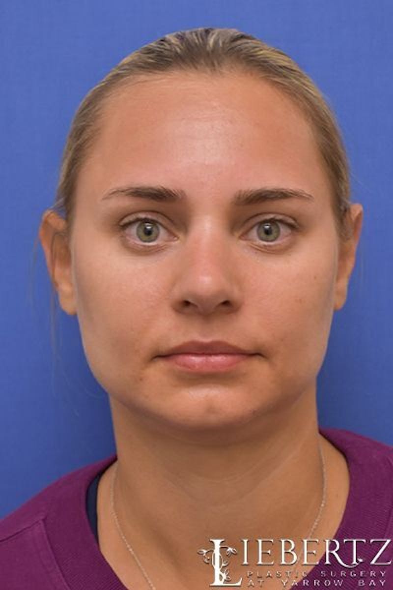 Rhinoplasty Before & After Gallery - Patient 317114 - Image 4