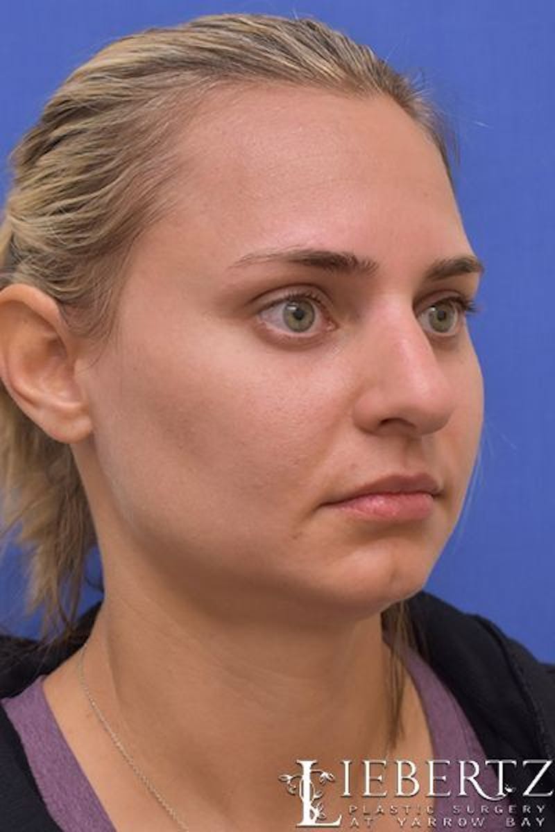 Rhinoplasty Before & After Gallery - Patient 317114 - Image 5