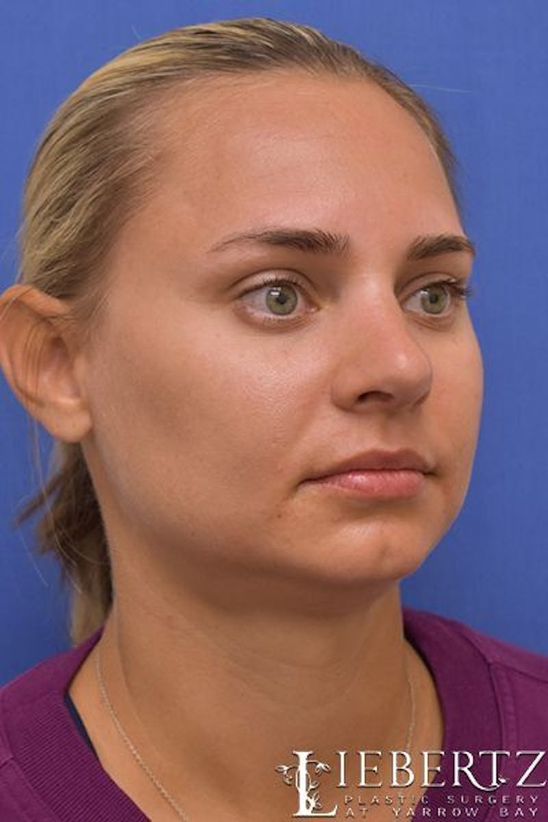 Rhinoplasty Before & After Gallery - Patient 317114 - Image 4
