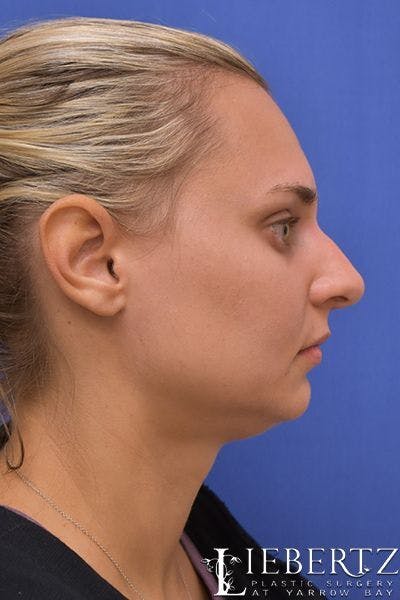 Rhinoplasty Before & After Gallery - Patient 317114 - Image 1