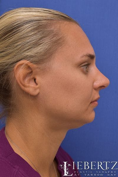 Rhinoplasty Before & After Gallery - Patient 317114 - Image 2