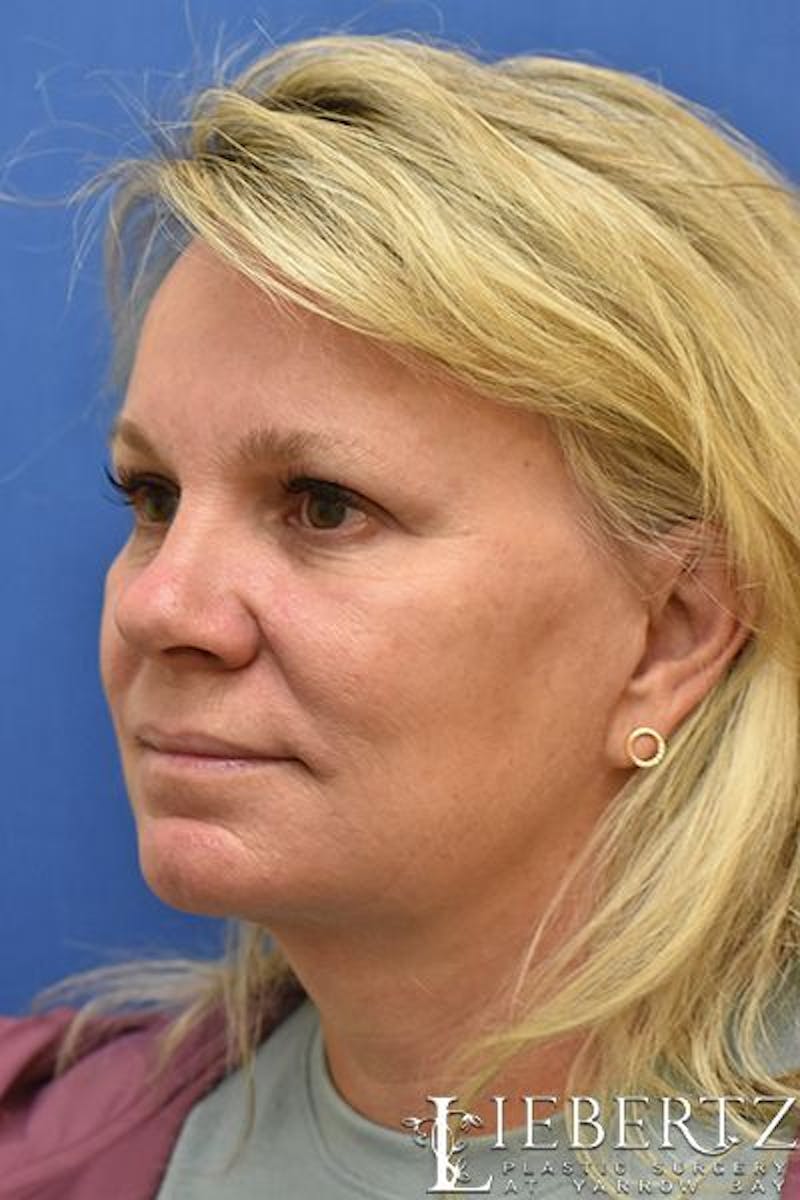 Necklift Before & After Gallery - Patient 145797 - Image 4