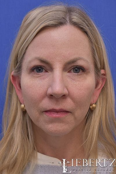 Blepharoplasty Before & After Gallery - Patient 403966 - Image 2