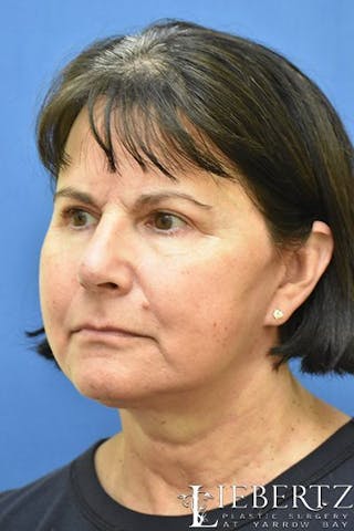 Necklift Before & After Gallery - Patient 250128 - Image 4