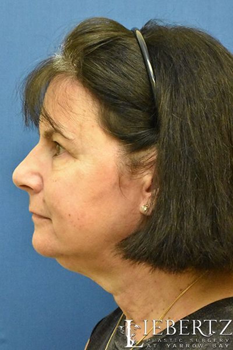 Necklift Before & After Gallery - Patient 250128 - Image 5