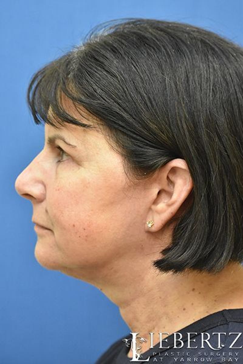 Necklift Before & After Gallery - Patient 250128 - Image 6