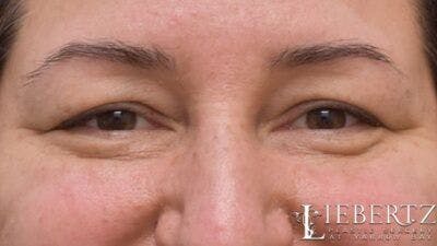 Blepharoplasty Before & After Gallery - Patient 745456 - Image 1