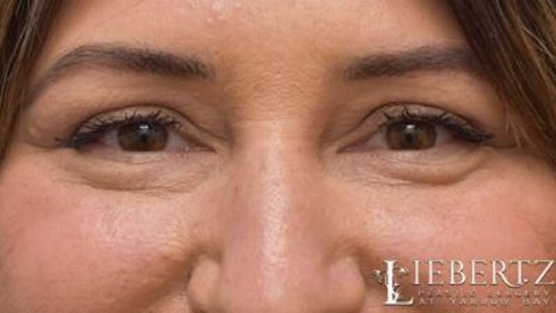 Blepharoplasty Before & After Gallery - Patient 745456 - Image 2